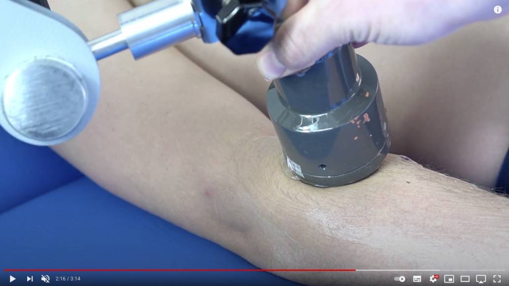 Il trattamento di casi specifici con i crioultrasuoni - Guarda di video
